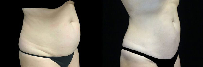 CoolSculpting Before After Photos Stomach