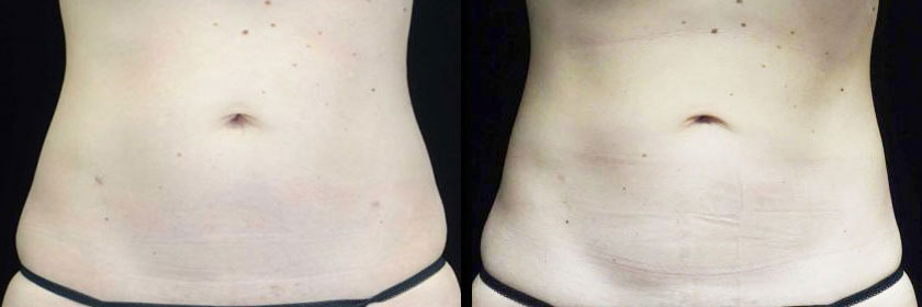 CoolSculpting Before After Photos Abdomen