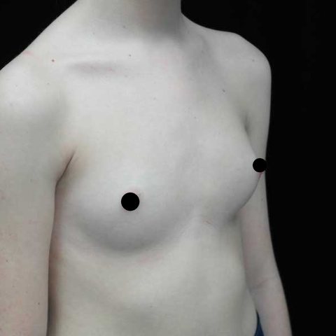 Breasts before treatment, three-quarter view