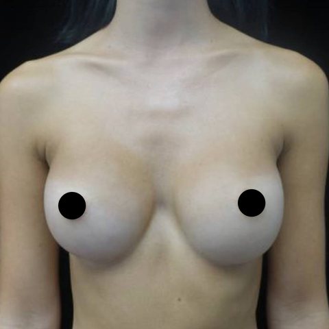 Breasts after treatment, front view