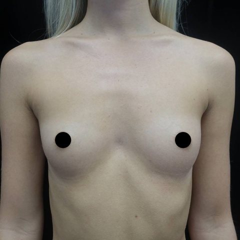 Breasts before treatment, front view