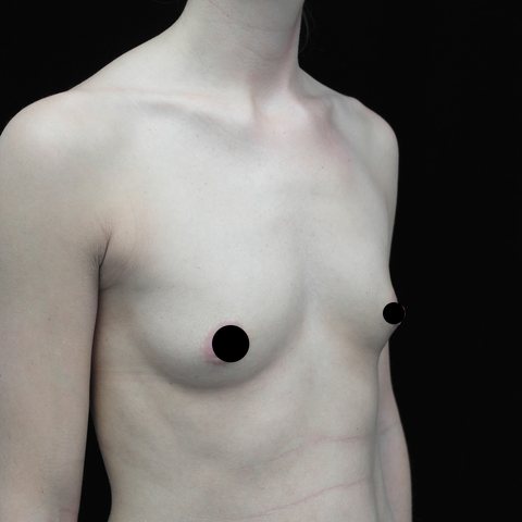 Breasts before treatment, three-quarter view