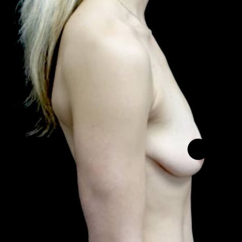 Breast before treatment, side view