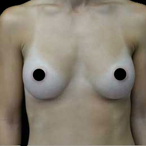 Breasts after treatment, front view
