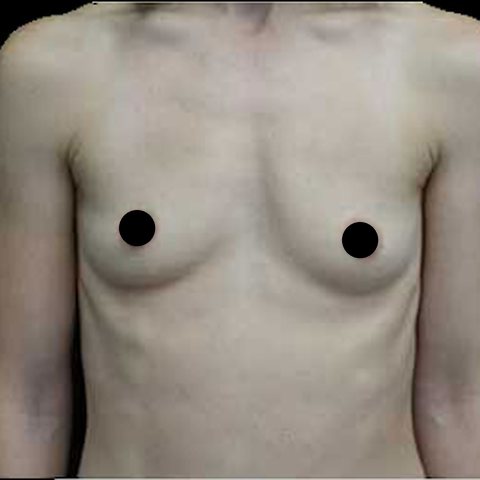 Breasts before treatment, front view