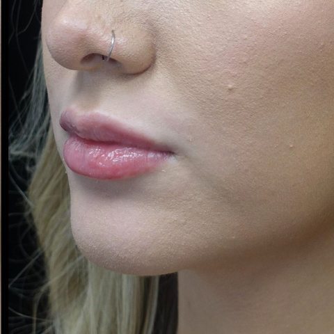 Lips after treatment, side view