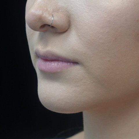 Lips before treatment, side view