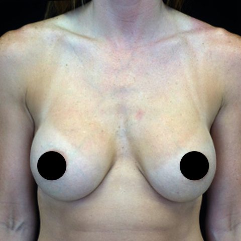 Breasts after treatment, front view