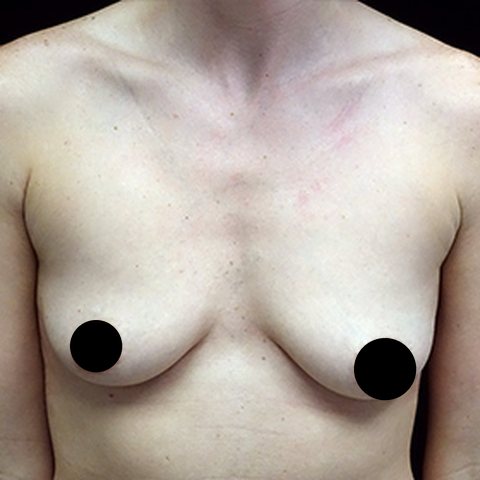 Breasts before treatment, front view