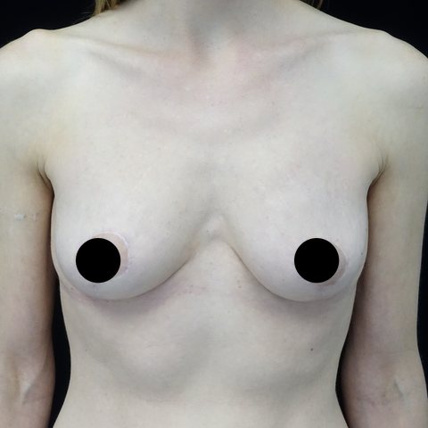 Breasts after treatment, front view