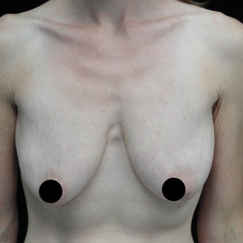 Breasts before treatment, front view