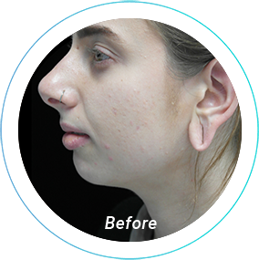chin augmentation plastic surgery before and after pittsburgh