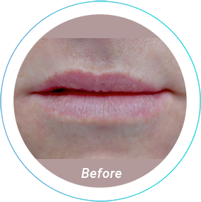 lip augmentation plastic surgery before and after pittsburgh