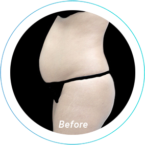 tummy tuck plastic surgery before and after pittsburgh
