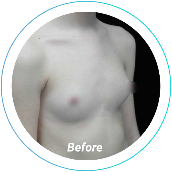 breast augmentation plastic surgery before and after pittsburgh set 1