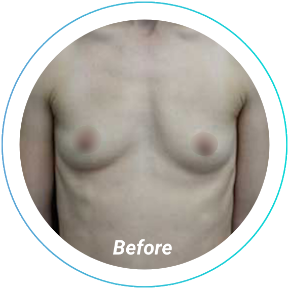 breast augmentation plastic surgery before and after pittsburgh set 10