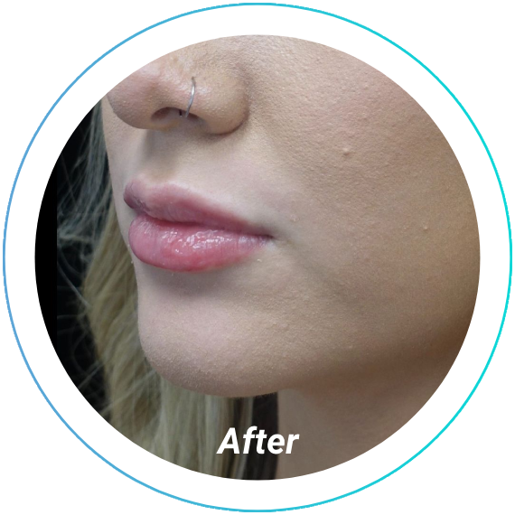 lip fillers plastic surgery before and after pittsburgh set 11