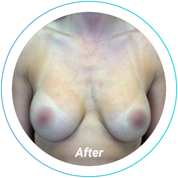 breast augmentation plastic surgery before and after pittsburgh set 12