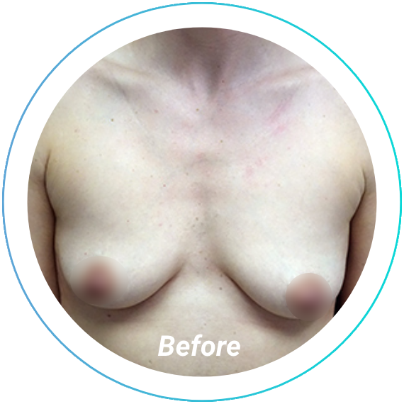 breast augmentation plastic surgery before and after pittsburgh set 12