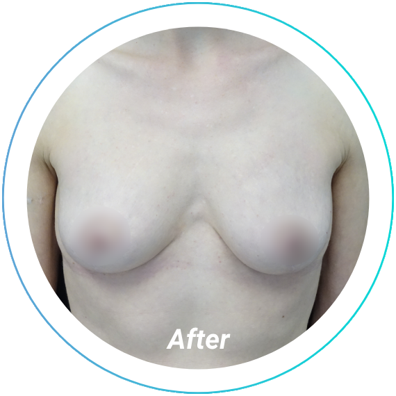 breast lift plastic surgery before and after pittsburgh set 13