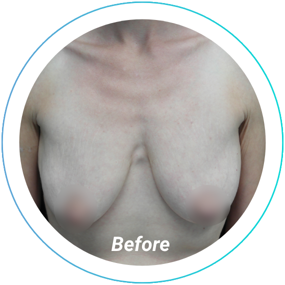 breast lift plastic surgery before and after pittsburgh set 13