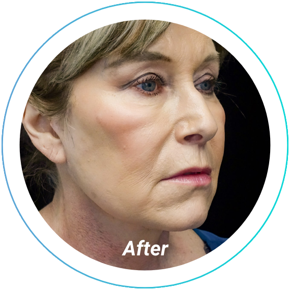 chemical peel plastic surgery before and after pittsburgh set 5