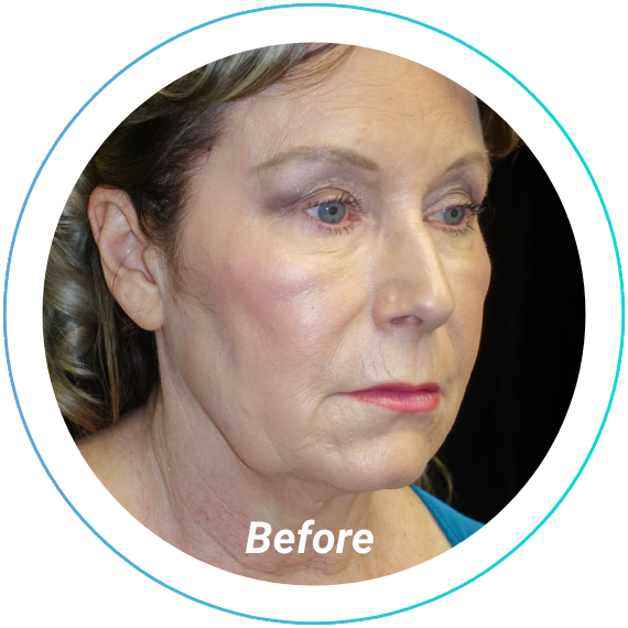 chemical peel plastic surgery before and after pittsburgh set 5