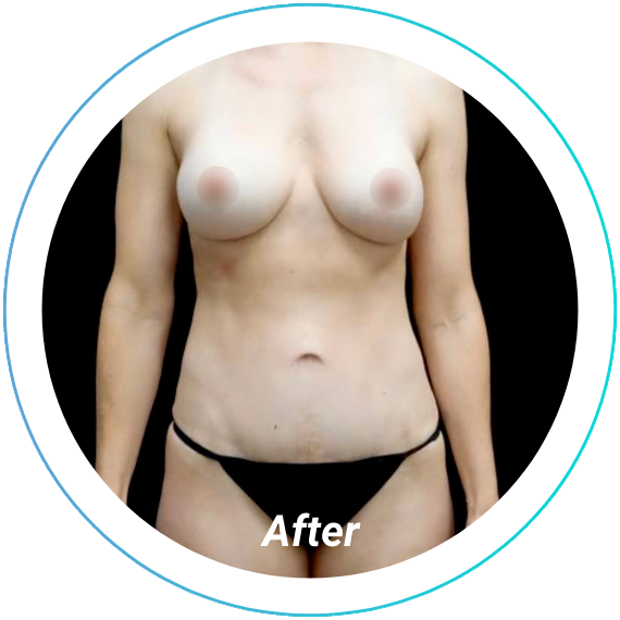 breast augmentation plastic surgery before and after pittsburgh set 2