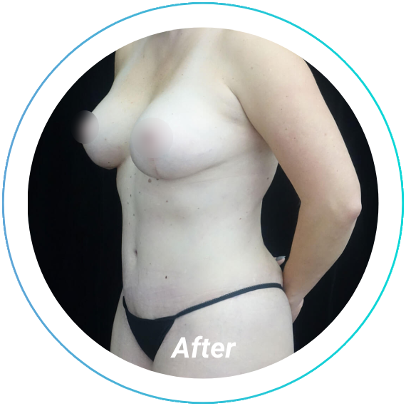 mommy makeover plastic surgery before and after pittsburgh set 3