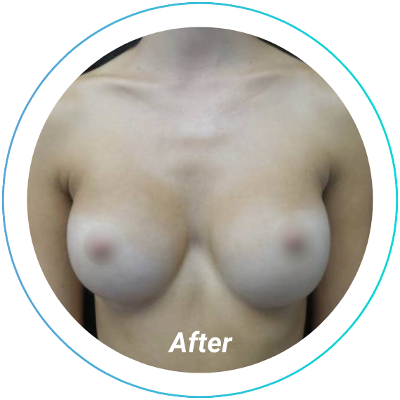 breast augmentation plastic surgery before and after pittsburgh set 4