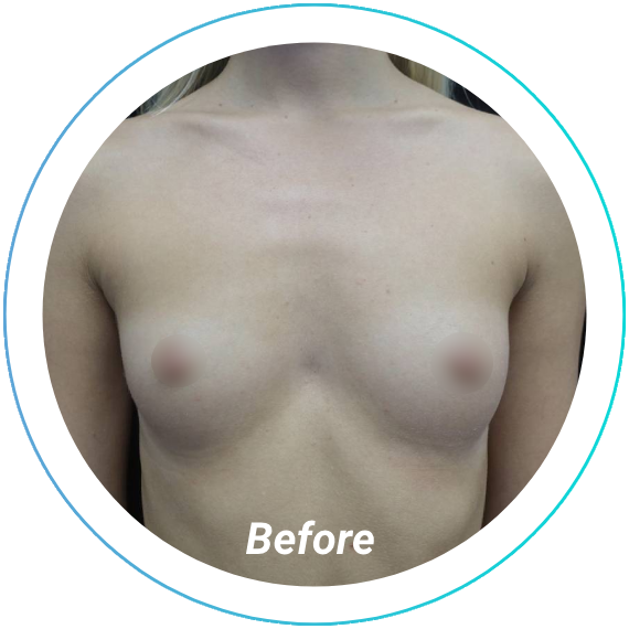 breast augmentation plastic surgery before and after pittsburgh set 4