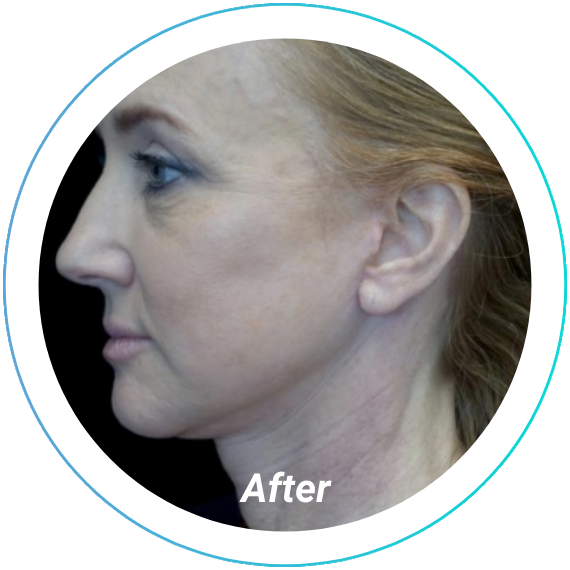 chemical peel plastic surgery before and after pittsburgh set 5