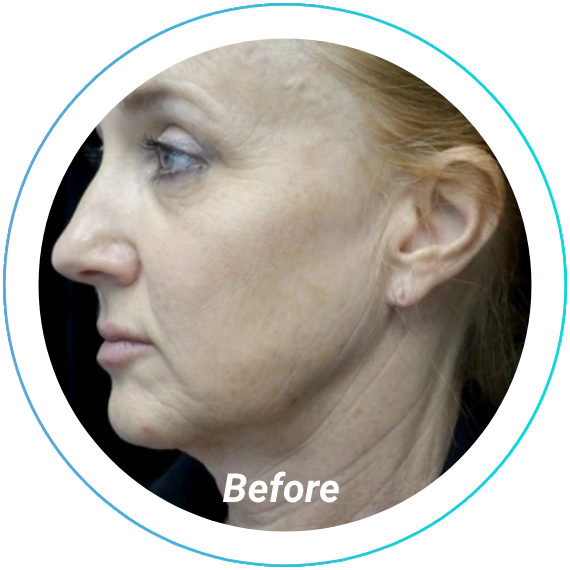 chemical peel plastic surgery before and after pittsburgh set 5