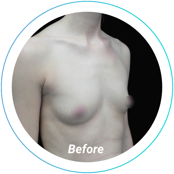 breast augmentation plastic surgery before and after pittsburgh set 6