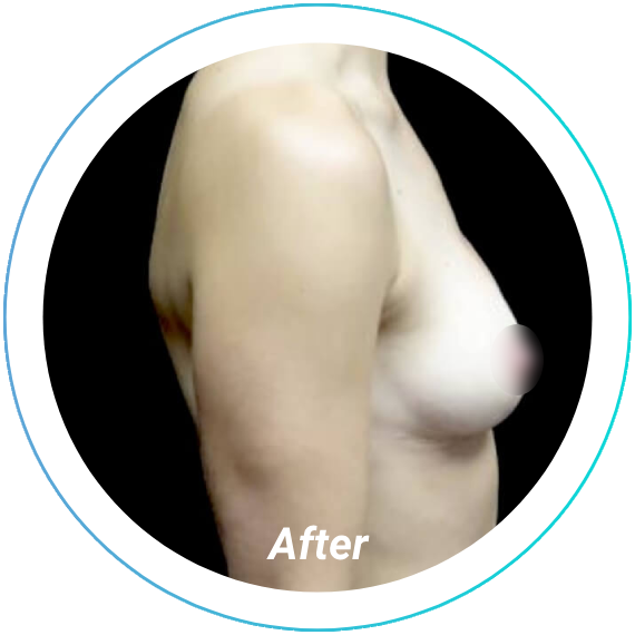 breast lift plastic surgery before and after pittsburgh set 7