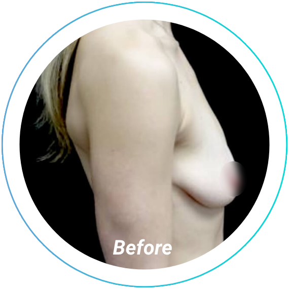 breast lift plastic surgery before and after pittsburgh set 7