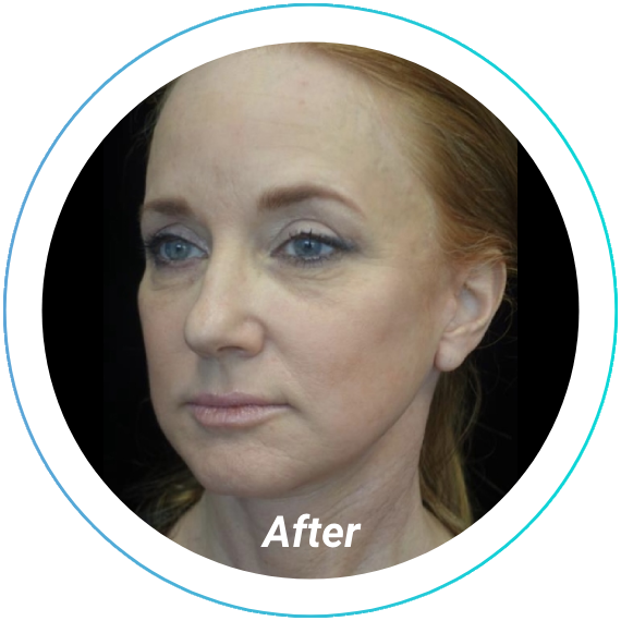 chemical peel plastic surgery before and after pittsburgh set 8