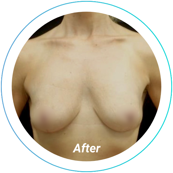 breast lift plastic surgery before and after pittsburgh set 9