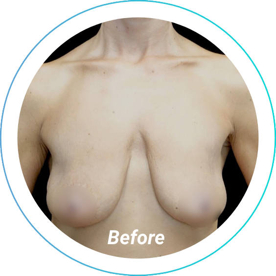 breast lift plastic surgery before and after pittsburgh set 9