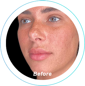 rhinoplasty plastic surgery before and after pittsburgh