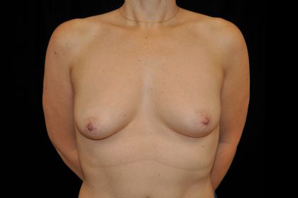 Breast Reconstructions Before & After Patient #15212