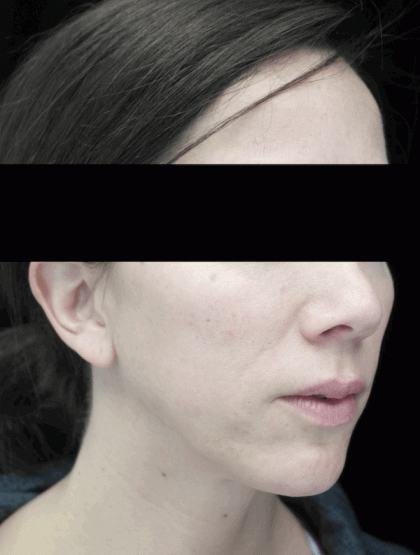 Chin Implants (Augmentation) Before & After Patient #14816