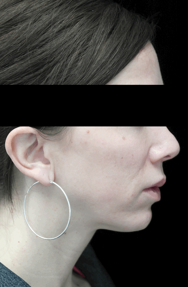 Chin Implants (Augmentation) Before & After Patient #14816
