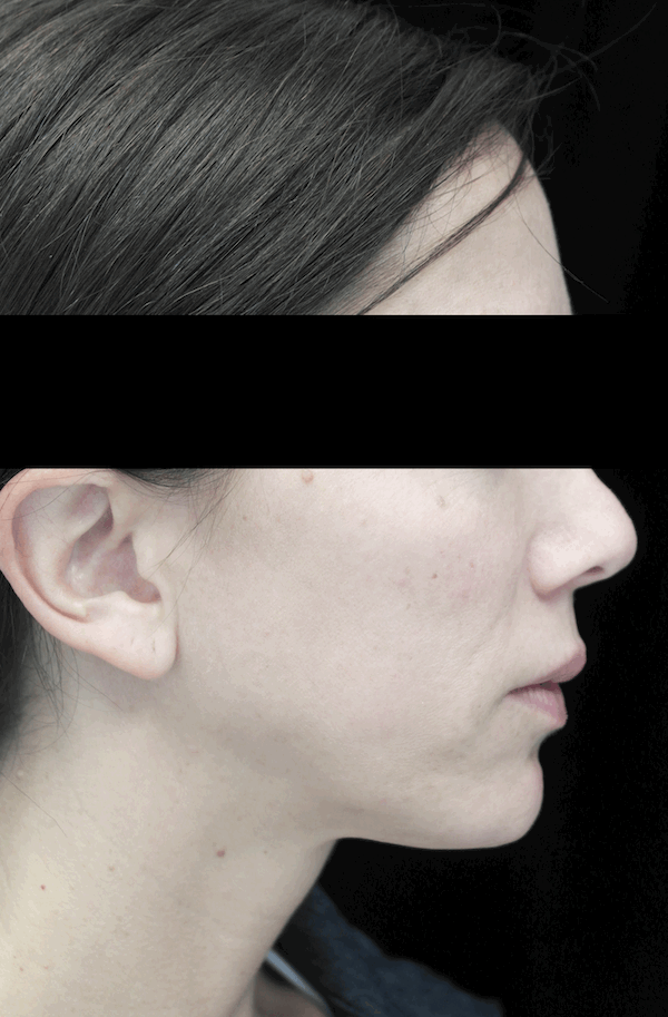 Chin Implants (Augmentation) Before & After Patient #14816