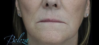 Fat Transfer to Face Before & After Patient #14934