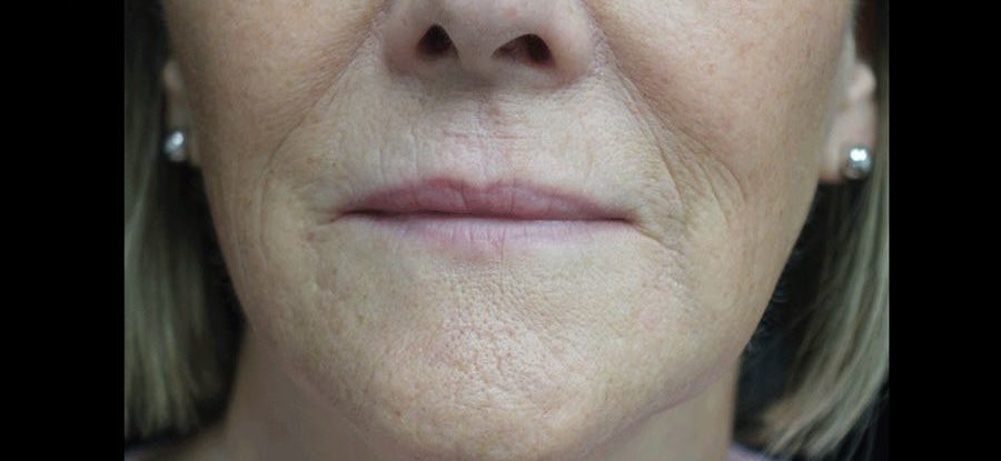 Fat Transfer to Face Before & After Patient #14934