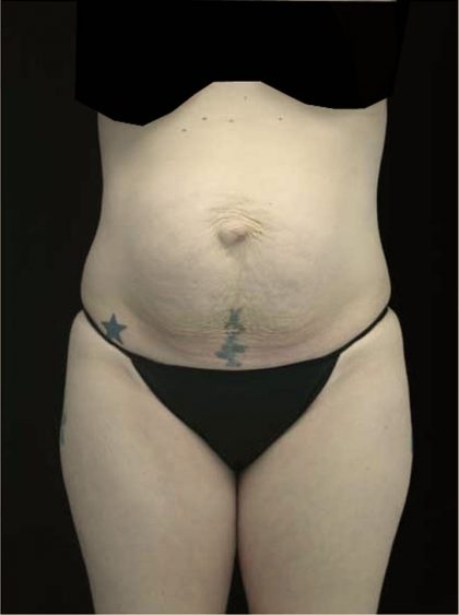 Tummy Tuck Before & After Patient #14992