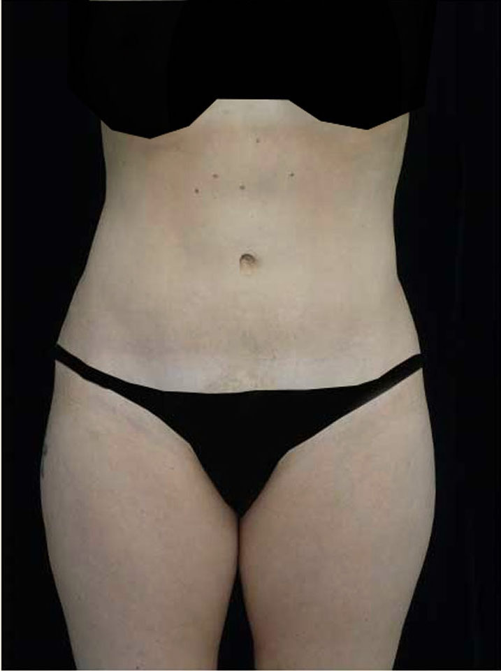 Tummy Tuck Before & After Patient #14992