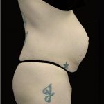 Tummy Tuck Before & After Patient #14992