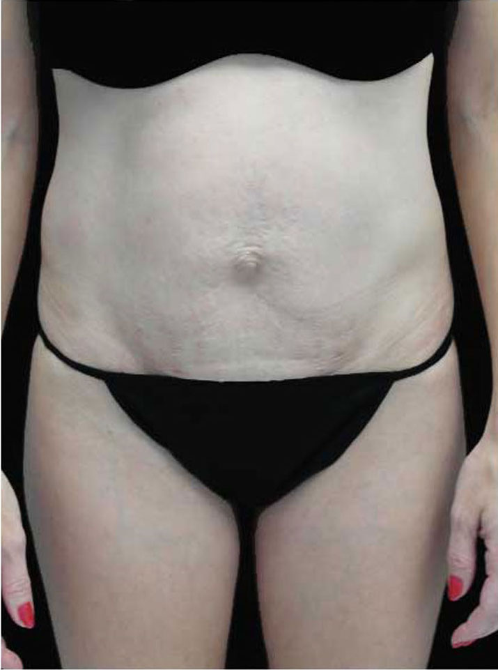 Tummy Tuck Before & After Patient #15062